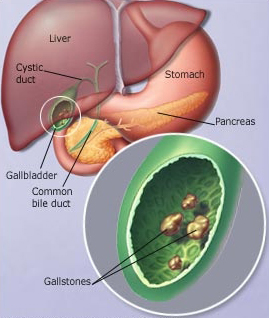 gallstone image