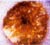 Image of Kidney Stone