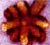 Image of Kidney Stone