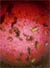 Image of Kidney Stone