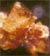 Image of Kidney Stone